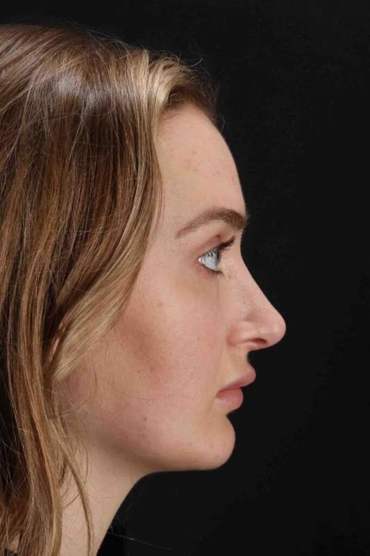 Browlift Before & After Patient #1297
