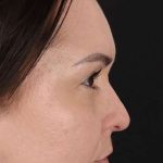 Liquid Rhinoplasty Before & After Patient #2243