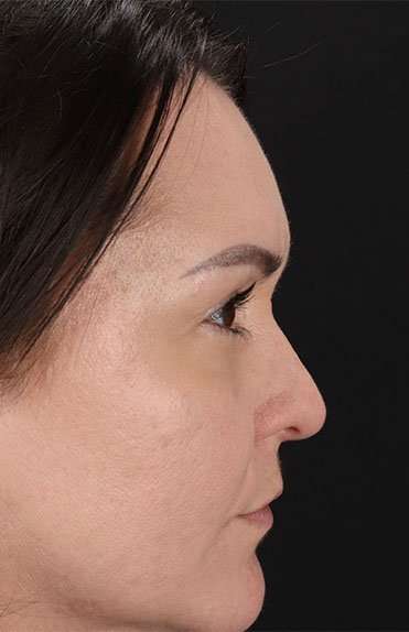 Liquid Rhinoplasty Before & After Patient #2243