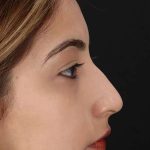 Liquid Rhinoplasty Before & After Patient #2254