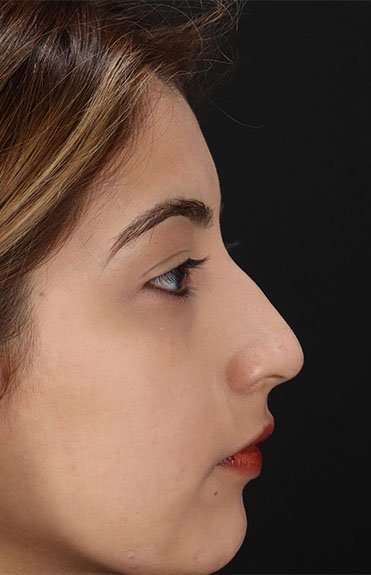 Liquid Rhinoplasty Before & After Patient #2254