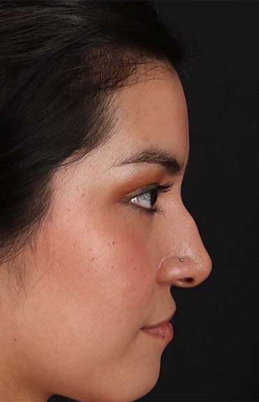 Liquid Rhinoplasty Before & After Patient #2265