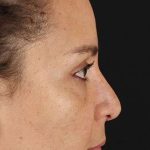 Liquid Rhinoplasty Before & After Patient #2276