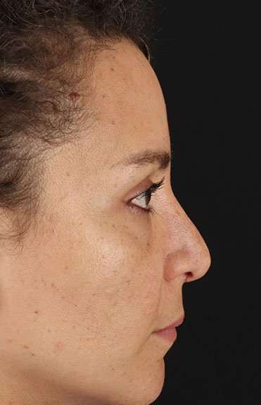 Liquid Rhinoplasty Before & After Patient #2276