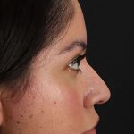 Liquid Rhinoplasty Before & After Patient #2290