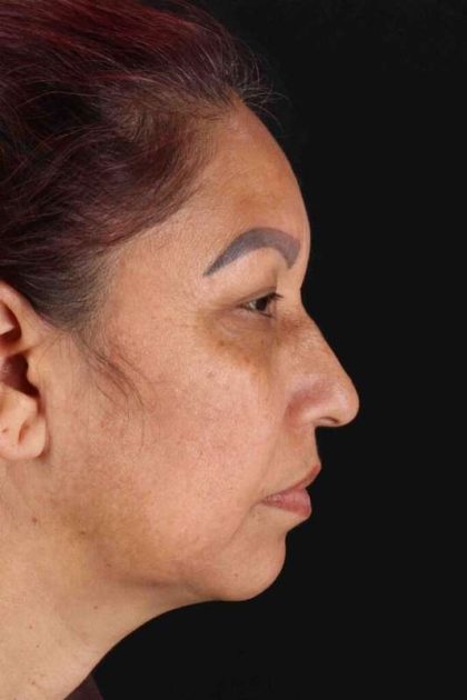 Lower Blepharoplasty Before & After Patient #2321