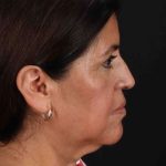 Lower Blepharoplasty Before & After Patient #2343