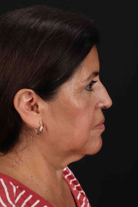 Lower Blepharoplasty Before & After Patient #2343