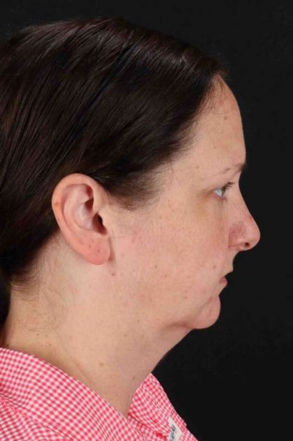 Lower Blepharoplasty Before & After Patient #2354