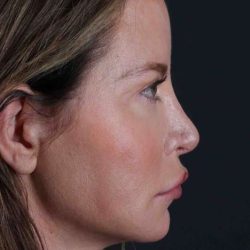 Browlift Before & After Patient #1308