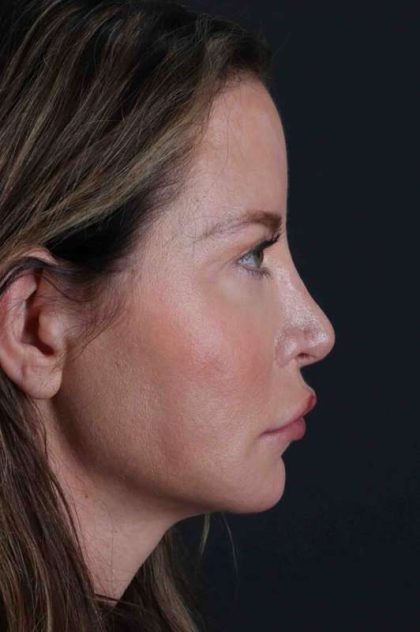 Browlift Before & After Patient #1308