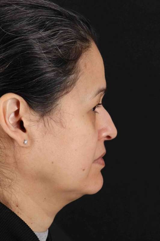 Lower Blepharoplasty Before & After Patient #2365