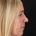 Lower Blepharoplasty Before & After Patient #2376