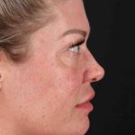 Lower Blepharoplasty Before & After Patient #2387