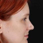 Lower Blepharoplasty Before & After Patient #2409