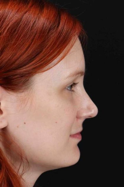 Lower Blepharoplasty Before & After Patient #2409