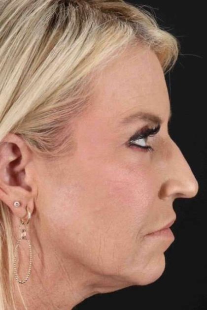 Neck Lift Before & After Patient #2430