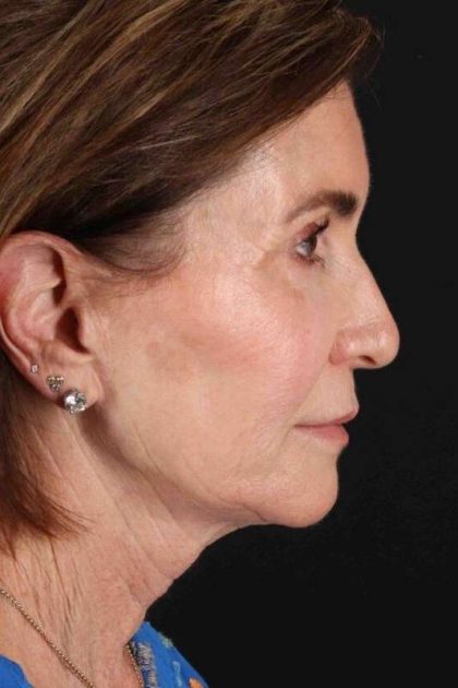 Neck Lift Before & After Patient #2452