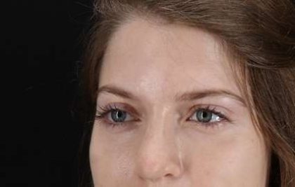 Browlift Before & After Patient #1319