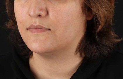 Neck Lift Before & After Patient #2560