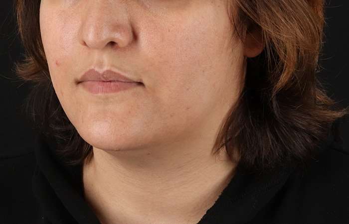 Neck Lift Before & After Patient #2560