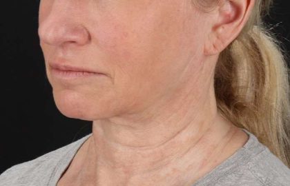 Neck Lift Before & After Patient #2571