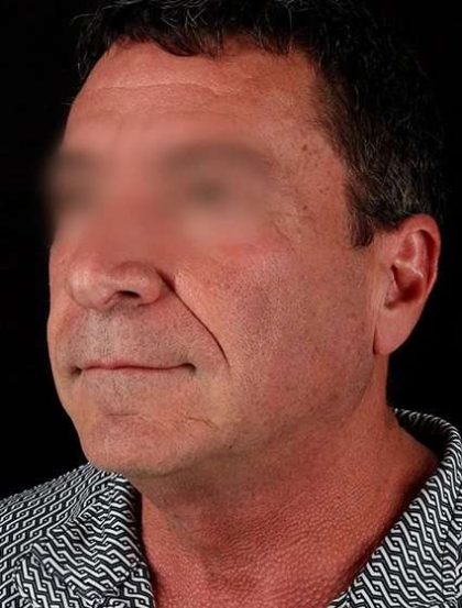 Neck Lift Before & After Patient #2604
