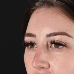 Browlift Before & After Patient #1330