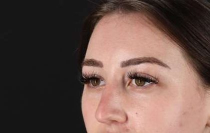 Browlift Before & After Patient #1330