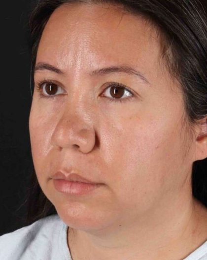 Neck Liposuction Before & After Patient #2741