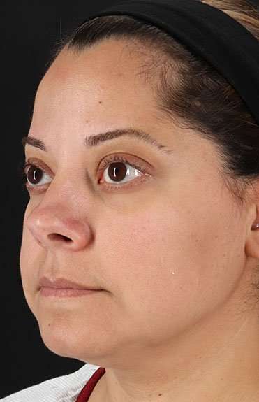 Neck Liposuction Before & After Patient #2752