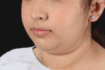 Neck Liposuction Before & After Patient #2774