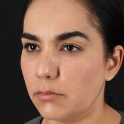 Browlift Before & After Patient #1341