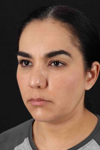 Browlift Before & After Patient #1341
