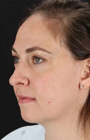Neck Liposuction Before & After Patient #2785