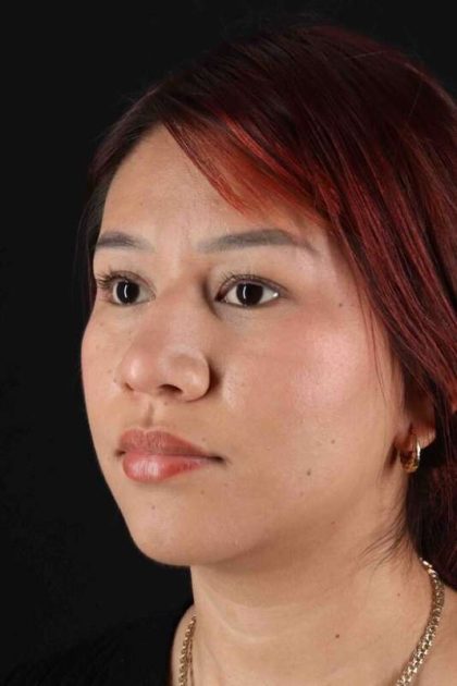 Rhinoplasty Before & After Patient #2829