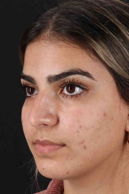 Rhinoplasty Before & After Patient #2862