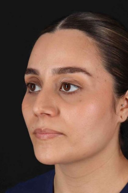 Rhinoplasty Before & After Patient #2873