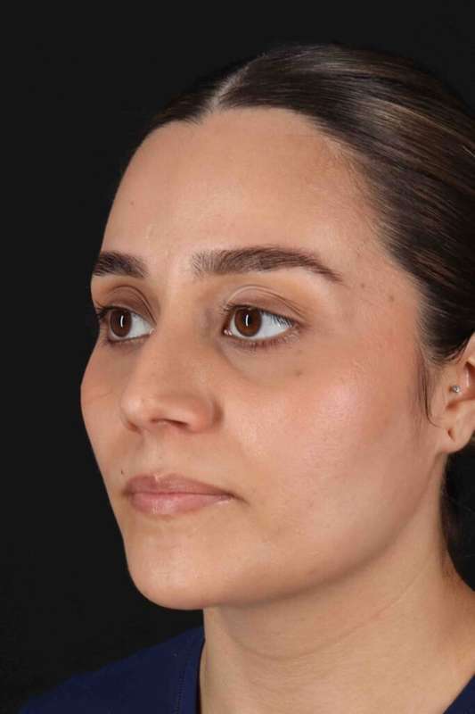 Rhinoplasty Before & After Patient #2873