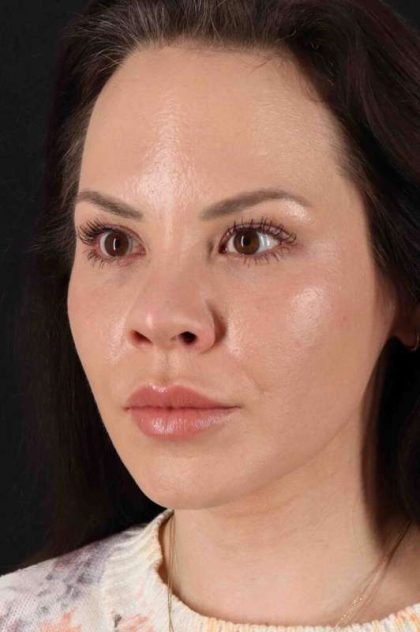 Rhinoplasty Before & After Patient #2884