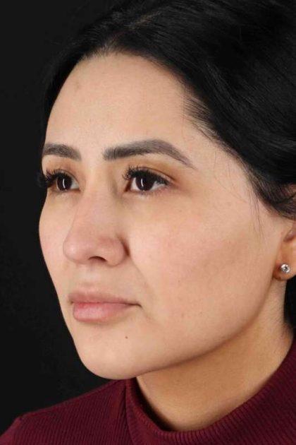Rhinoplasty Before & After Patient #2895