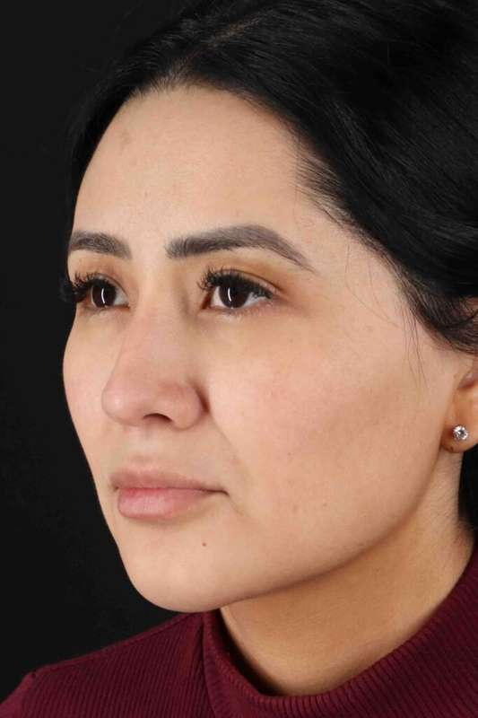 Rhinoplasty Before & After Patient #2895
