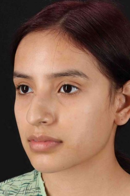 Rhinoplasty Before & After Patient #2917