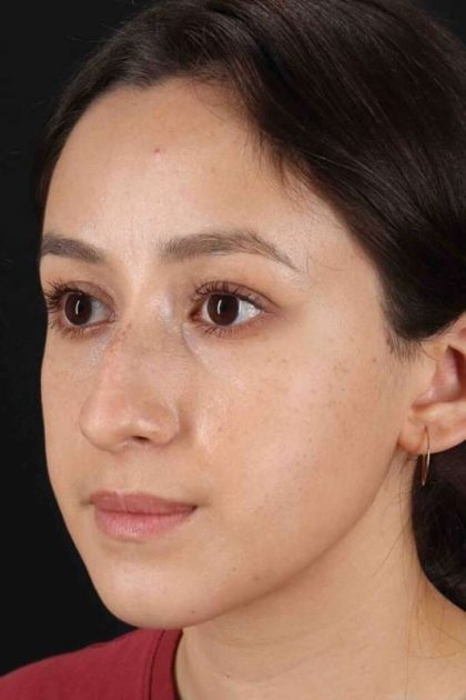 Rhinoplasty Before & After Patient #2928