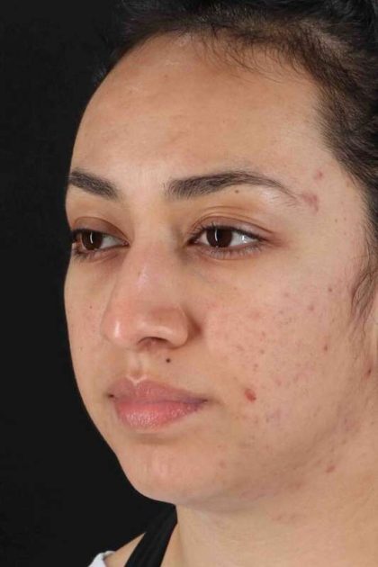 Rhinoplasty Before & After Patient #2939