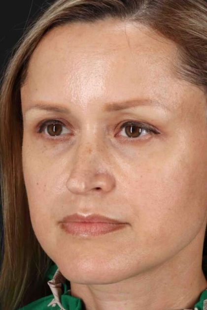 Rhinoplasty Before & After Patient #2950