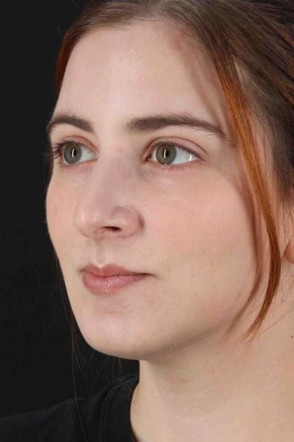 Rhinoplasty Before & After Patient #2961