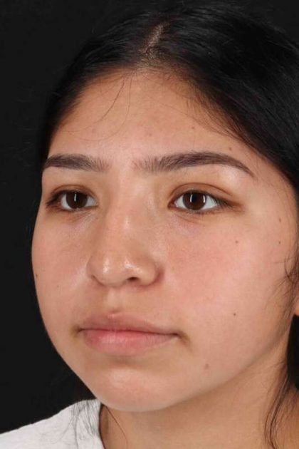 Rhinoplasty Before & After Patient #2972