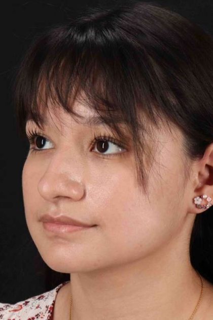 Rhinoplasty Before & After Patient #2983
