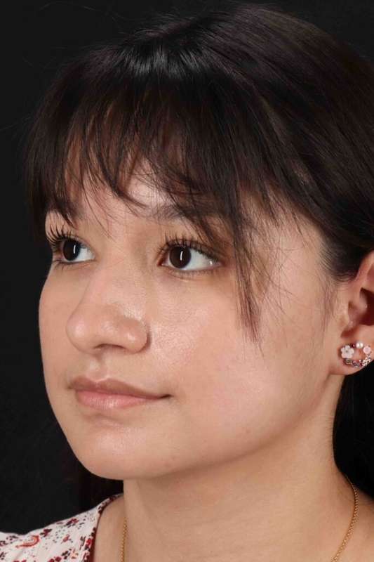 Rhinoplasty Before & After Patient #2983